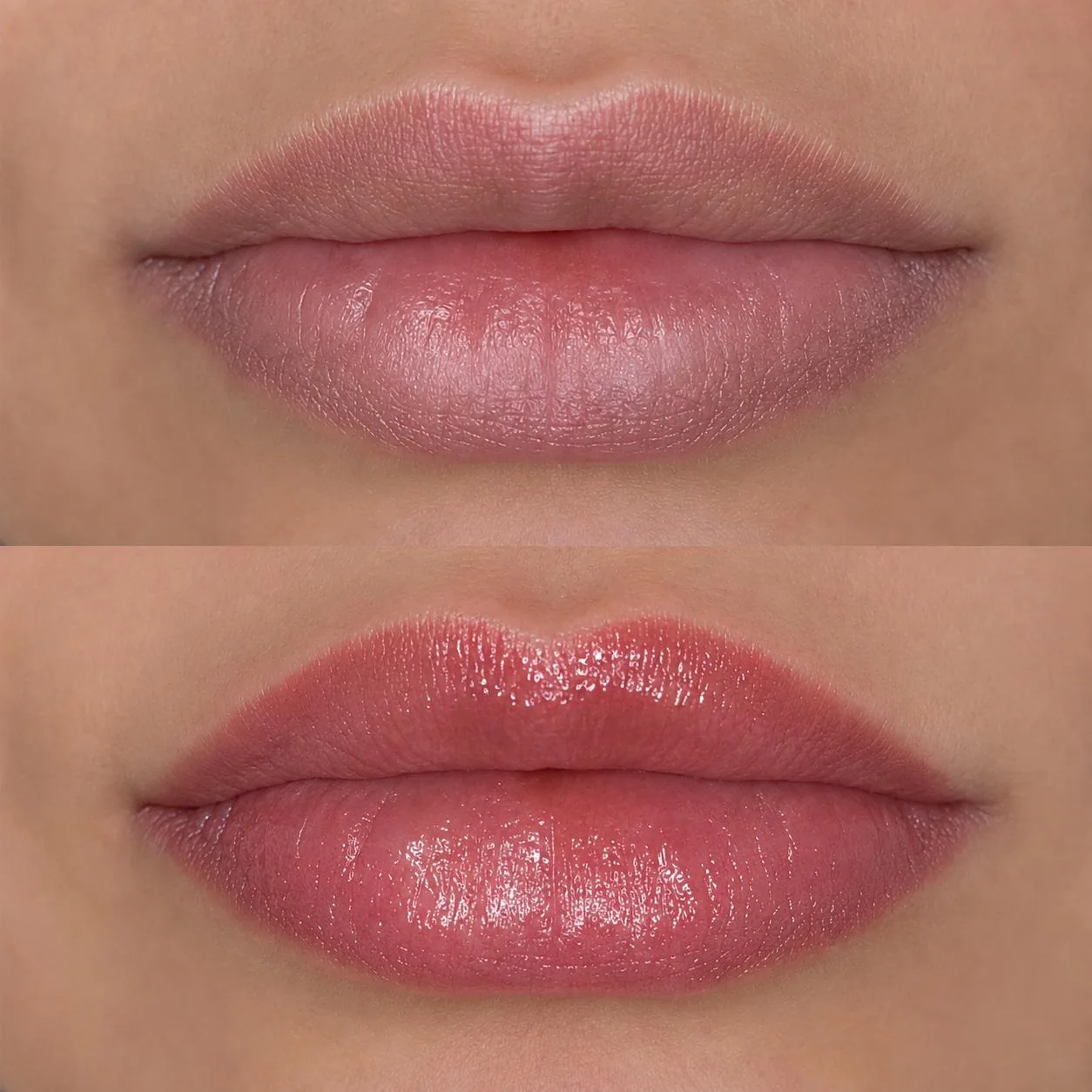 Antes e depois da revitalização labial